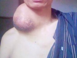 Derita Warga Sukakersa: Tumor Raksasa Di Leher, Pasrah Menanti Uluran Tangan