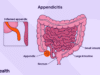 HDC-INFOGRAPHIC-Stages-of-Appendicitis-1-V1-1-b82cec7d8631478c8d2f84835557a9cc